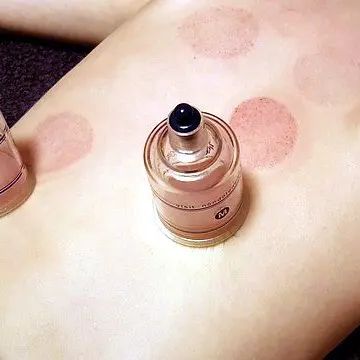 Schröpf-Therapie & Schröpf-Massage